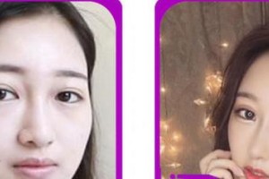 廈門海明醫(yī)療美容診所李萬福整形價格表附鼻部綜合案例展示