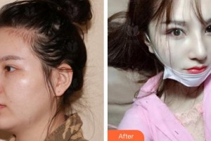 廈門蘭的整形外科門診部趙曉暉整形價格表附肋軟骨隆鼻案例展示