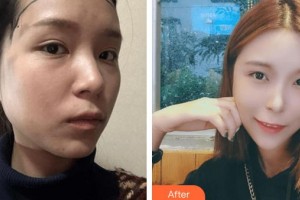 廈門銀河整形美容醫(yī)院李江濱整形價格表附女性發(fā)際線種植案例展示