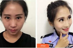 廈門臻醫(yī)醫(yī)療美容門診部盧丹鳳整形價格表附黃金微針案例展示