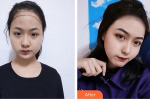 廈門碧蓮盛植發(fā)醫(yī)療美容門診部趙陽整形價(jià)格表附美女發(fā)際線種植案例展示