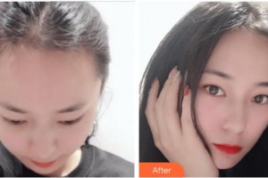 廈門碧蓮盛植發(fā)醫(yī)療美容門診部林威特整形價(jià)格表附發(fā)際線種植案例展示