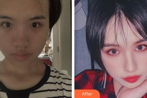 廈門顏施整形外科門診部林高萍整形價(jià)格表附面部埋線提升提升案例展示