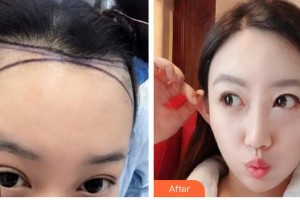 廈門重森植發(fā)整形外科門診部胡荔平整形價(jià)格表附發(fā)際線種植案例展示
