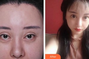 廈門大學(xué)附屬廈門眼科中心醫(yī)院蔡錦紅整形價(jià)格表附失敗重瞼修復(fù)+上瞼下垂矯正案例展示