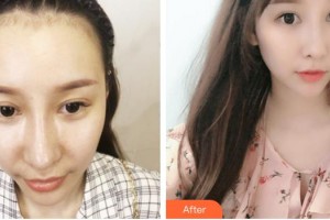 廈門雍禾植發(fā)醫(yī)療美容門診部潘朝林整形價(jià)格表附美人尖微創(chuàng)種植 發(fā)際線高案例展示