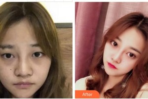 廈門大學(xué)附屬廈門眼科中心醫(yī)院吳仁毅整形價(jià)格表附眼部手術(shù)案例展示