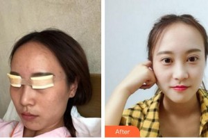 廈門大學(xué)附屬廈門眼科中心醫(yī)院劉志雄整形價(jià)格表附眼部手術(shù)案例展示