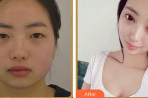 廈門大學(xué)附屬廈門眼科中心醫(yī)院毛祖紅整形價(jià)格表附眼部多項(xiàng)案例展示