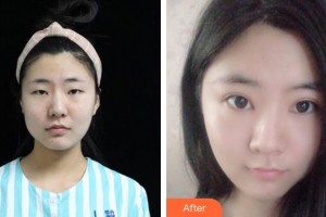 廈門大學(xué)附屬廈門眼科中心醫(yī)院崔麗飛整形價(jià)格表附眼部案例展示