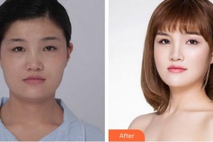 廈門大學(xué)附屬廈門眼科中心醫(yī)院何雪洪整形價(jià)格表附眼部綜合日記案例展示