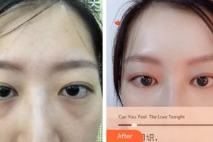 廈門大學(xué)附屬廈門眼科中心醫(yī)院許亞章整形價(jià)格表附內(nèi)路去眼袋案例展示