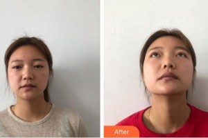 廈門大學(xué)附屬廈門眼科中心醫(yī)院王晶整形價(jià)格表附美眼部手術(shù)案例展示