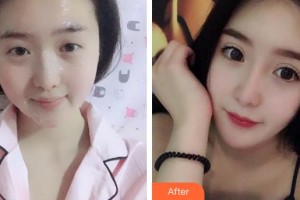 廈門大學(xué)附屬廈門眼科中心醫(yī)院周山整形價(jià)格表附眼部綜合案例展示