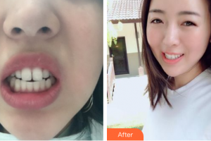 廣州醫(yī)學(xué)院口腔醫(yī)院何錦泉住院醫(yī)師整形價格表附隱形矯正案例展示