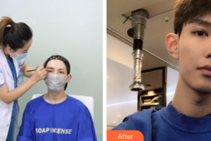 廣州中家醫(yī)家庭醫(yī)生醫(yī)學(xué)整形美容醫(yī)院趙蕓藝整形價格表附種植眉毛案例展示