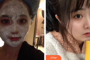 廣州博仕整形美容醫(yī)院劉亞光整形價格表附四代熱瑪吉案例展示