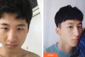 廣州解放軍第四五八醫(yī)院激光整形美容中心李筱珺整形價格表附鼻部手術(shù)案例展示