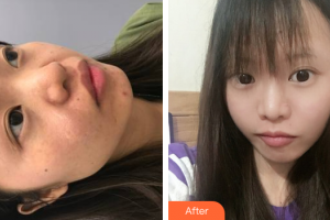 廣州解放軍第四五八醫(yī)院激光整形美容中心鄭燕妮整形價格表附面部疤痕去除案例展示