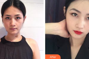 廣州鴻業(yè)醫(yī)學(xué)美容門診部巫勝君整形價格表附增生疤痕案例展示