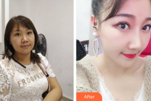 廣州解放軍第四五八醫(yī)院激光整形美容中心劉躍飛整形價格表附隆鼻案例展示