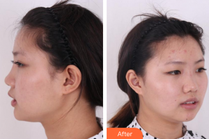 廣州鴻業(yè)醫(yī)學(xué)美容門診部羅良俊整形價格表附鼻部綜合案例展示