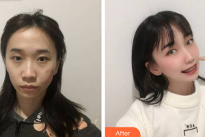 廣州鴻業(yè)醫(yī)學(xué)美容門診部劉相勇整形價格表附縫針疤痕案例展示