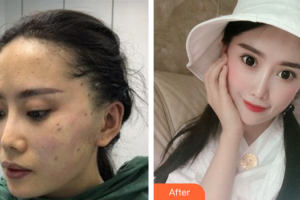 廣州廣大整形美容醫(yī)院查旭山整形價格表附埋線提升案例展示