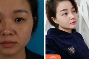 廣州廣大整形美容醫(yī)院程喜平整形價格表附鼻部手術(shù)案例展示
