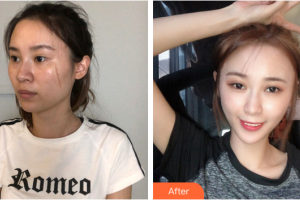 廣州鴻業(yè)醫(yī)學(xué)美容門診部陳杏整形價格表附點陣激光去痘印痘坑案例展示