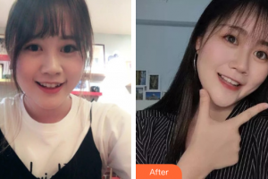 廣州曙光醫(yī)學(xué)美容醫(yī)院王浩整形價格表附金屬托槽矯正案例展示