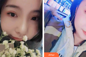 廣州新時代整形美容醫(yī)院文夫整形價格表附隱適美矯正案例展示