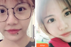 廣州廣大整形美容醫(yī)院任生整形價格表附自體脂肪填充案例展示