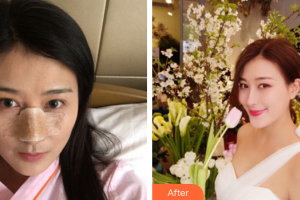 廣州中科美整形醫(yī)院鄭志敏整形價格表附鼻部手術(shù)案例展示