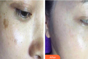 南方醫(yī)科大學(xué)附屬廣州燕嶺醫(yī)院整形美容中心郭芳整形價格表附激光祛色素沉著疤痕案例展示