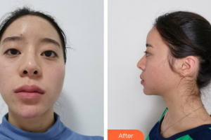 廣州博仕整形美容醫(yī)院蔡偉平整形價格表附切開雙眼皮案例展示