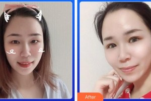 廈門大學(xué)附屬廈門眼科中心醫(yī)院李東侃整形價(jià)格表附眼部案例展示