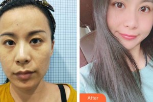 廈門大學(xué)附屬廈門眼科中心醫(yī)院徐法松整形價(jià)格表附上瞼提肌案例展示