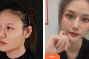 廈門大學(xué)附屬廈門眼科中心醫(yī)院徐靜靜整形價(jià)格表附眼部案例展示