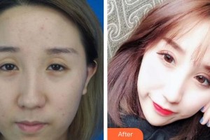 廈門大學(xué)附屬廈門眼科中心醫(yī)院歐陽文博整形價(jià)格表附切開雙眼皮案例案例展示