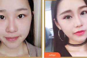 廈門大學(xué)附屬廈門眼科中心醫(yī)院范巍整形價(jià)格表附眼部綜合案例展示