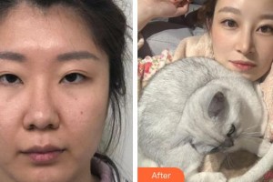 廈門大學(xué)附屬廈門眼科中心醫(yī)院商旭敏整形價(jià)格表附眼部整形案例展示