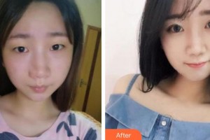 廈門大學(xué)附屬廈門眼科中心醫(yī)院葉梅整形價(jià)格表附自然雙眼皮案例展示