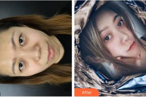 廈門大學(xué)附屬廈門眼科中心醫(yī)院曾宗圣整形價(jià)格表附切開雙眼皮案例展示