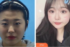 廈門大學(xué)附屬廈門眼科中心醫(yī)院羅順榮整形價(jià)格表附眼部手術(shù)案例展示