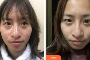 廈門大學(xué)附屬廈門眼科中心醫(yī)院修陽暉整形價(jià)格表附不開刀去眼袋+淚溝填充案例展示