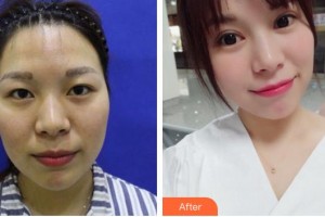 廈門大學(xué)附屬廈門眼科中心醫(yī)院陳雙成整形價(jià)格表附全切雙眼皮案例展示