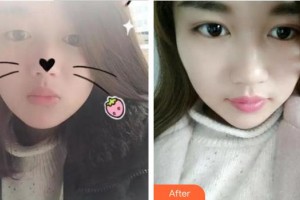 廈門大學(xué)附屬廈門眼科中心醫(yī)院楊美瓊整形價(jià)格表附眼部手術(shù)案例展示