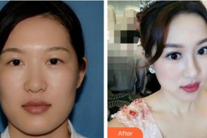 廈門大學(xué)附屬廈門眼科中心醫(yī)院謝仁藝整形價(jià)格表附雙眼皮修復(fù)案例展示