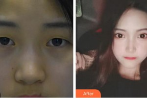 廈門大學(xué)附屬廈門眼科中心醫(yī)院陳文生整形價(jià)格表附眼部手術(shù)案例展示